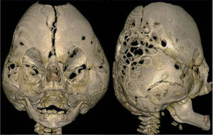Imágenes de Kleeblattschädel o cloverleaf skull, que muestran una fusión prematura de las suturas coronal, sagital y lambdoidea. Imágenes cedidas por gentileza del Dr. Paritosh C. Khanna.
