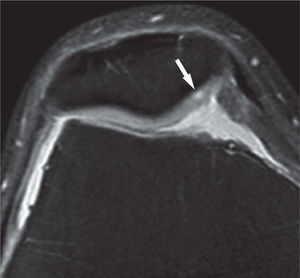 Lesión de grado I: la flecha muestra una vesiculación en el cartílago, consecuencia de la alteración de su contenido de agua y proteoglucanos. Corte axial ponderado en densidad protónica con supresión grasa.