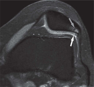 Lesión de grado III: se observa una grieta considerable en el cartílago patelar (flecha blanca) y una lesión reactiva subcondral (flecha gris). Corte axial ponderado en densidad protónica con supresión grasa.