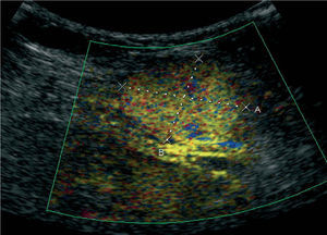 Imagen ecográfica con contraste, en la que se visualiza imagen nodular hipercaptante en fase arterial correspondiente al implante tumoral.