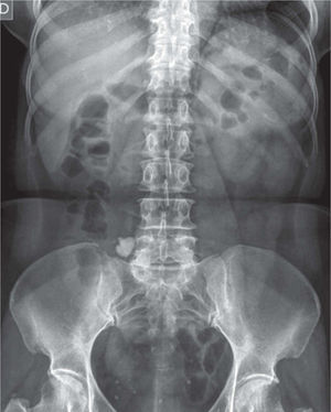Radiografía simple de abdomen como imagen basal donde se aprecia el granuloma calcificado en fosa ilíaca derecha. Llaman la atención también los flebolitos del área vesical.
