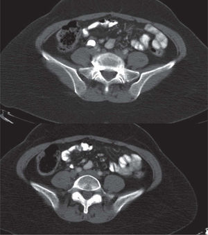 Cortes axiales en zona perilesional en fase excretora de la tomografía computarizada con contraste.