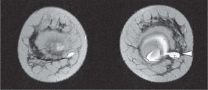 Resonancia magnética de mama. Ruptura de prótesis con migración de silicona de mama izquierda (punta de flecha).