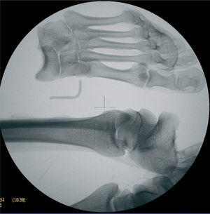 Radiografía de extremidades inferiores: líneas de Harris en el extremo distal de la tibia izquierda apreciándose el pie totalmente desarticulado. Letra L-left de alambre.