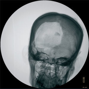 Radiografía de cráneo anteroposterior. Signos de excerebración con fractura de la lamina cribosa y apófisis crista galli. Fractura de la calota craneal por expoliación.