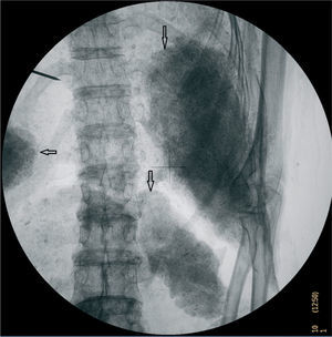 Radiografía de abdomen. Paquetes de vísceras momificadas en la cavidad abdominal.