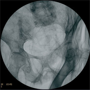 Radiografía de pelvis: asimetría pélvica y fémur en sable en individuo con signos radiológicos de osteomalacia.