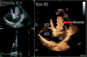 Imagen del mixoma auricular izquierdo mediante ecocardiografía tridimensional. AD: aurícula derecha; AI: aurícula izquierda; VD: ventrículo derecho; VI: ventrículo izquierdo.