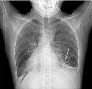 Radiografía de tórax posteroanterior. Dextrocardia (flecha negra), broquiestasias basales izquierdas (flecha blanca).