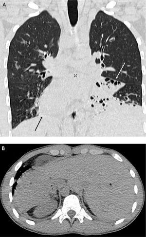 Tomografía computarizada de tórax. A. Reconstrucción coronal. Dextrocardia (flecha negra); bronquiectasias cilíndricas (flecha blanca). B. Corte axial a nivel del hemiabdomen superior. Hígado a la izquierda (*); bazo a la derecha (+). Situs inversus total.