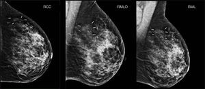 Comprobación mamográfica de los marcadores intramamarios peritumorales.