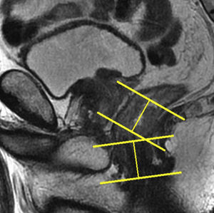 Tercio inferior. Cortes axiales oblicuos sobre el tumor, perpendiculares al canal anal y paralelos al margen anal.