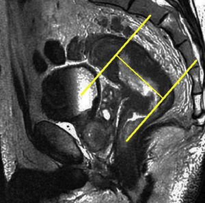 Planificación de los cortes axiales oblicuos del tumor, dispuestos perpendicularmente al eje cráneo-caudal de la masa tumoral.