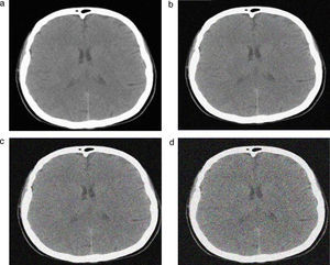 a) 336 mAs; b) 272 mAs; c) 209 mAs; d) 145 mAs.