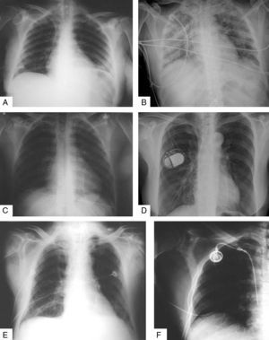 Las imágenes muestran la presencia de los catéteres más habituales en el tórax. A. muestra un catéter central de acceso periférico subclavio derecho con extremo entre vena cava superior y aurícula derecha. B. catéter venoso subclavio izquierdo demasiado introducido ya que presenta el extremo distal con un bucle en la aurícula derecha. C. radiografía demasiado hipervoltada, sin embargo nos permite apreciar otro catéter venoso subclavio derecho con un bucle pero en este caso fuera del trayecto intravascular con extremo distal correctamente colocado. D. imagen radiológica típica de un marcapasos. El extremo del electrodo se encuentra normalmente en ventrículo derecho. E. radiografía infra expuesta en la que se observa un catéter venoso subclavio izquierdo sin poder determinar la localización de su extremo distal. F. catéter Porth-a-cath derecho en el que se ha introducido contraste para comprobar su trayecto y permeabilidad. Se observa una pequeña fuga en el punto de entrada intravascular. Tanto en las imágenes B, C y E se observan múltiples cables de monitorización externo.