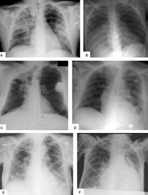 Las imágenes ilustran distintas patologías torácicas. A. muestra neumonía bilateral en lóbulo superior derecho e inferior izquierdo. B. atelectasia de la base pulmonar derecha, al ser visible el contorno cardíaco derecho corresponde el lóbulo inferior. C. colapso del lóbulo superior derecho que se traduce por la elevación de la cisura menor y desplazamiento retráctil de la tráquea hacia la derecha. D. la rotación de la imagen, a veces inevitable, provoca un falso ensanchamiento mediastínico. Por otro lado se observa un drenaje pleural en el hemitórax izquierdo. E. la imagen muestra prominencia de ambos hilios pulmonares y aumento del calibre de los vasos pulmonares, todo ello en relación con congestión vascular por fallo cardíaco. F. aumento muy importante de la silueta cardíaca debido a un gran derrame pericárdico. En todas las imágenes se observan múltiples cables de monitorización externo.