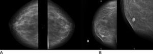 A) Mamografía de mamas normales. Proyección craneocaudal, mama derecha. B) Proyección oblicua y aumentada de nódulo espiculado de mama con criterios radiológicos de BIRAD IV y calcificaciones vasculares benignas en el cuadrante inferior de la mama derecha.