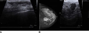 A) Ecografía benigna; se observa tejido mamario y músculo. B) Ecografía y mamografía con nódulo maligno; se observa un nódulo de forma irregular (ecografía) y pequeñas calcificaciones (mamografía).