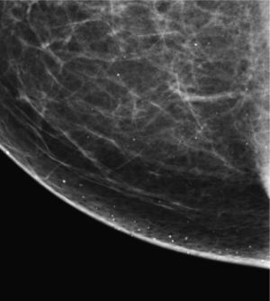 Calcificaciones cutáneas.