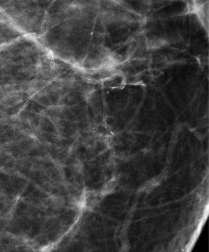 Carcinoma ductal in situ.