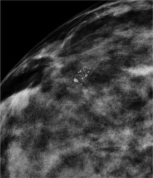 Carcinoma ductal infiltrante.