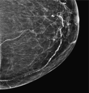 Calcificaciones vasculares.