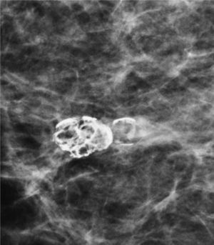 Calcificación de necrosis grasa.