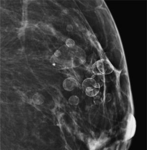 Quistes oleosos calcificados.