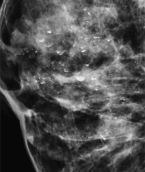 Calcificaciones intraquísticas.