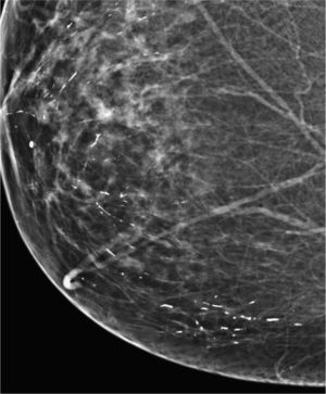 Calcificaciones de secreción láctea (mastitis de células plasmáticas).