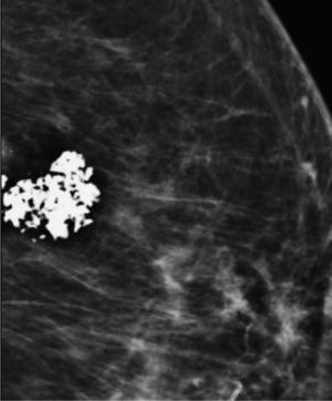 Fibroadenoma calcificado.