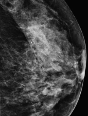 Microcalcificaciones indeterminadas extensas, estables en los controles periódicos estrictos.