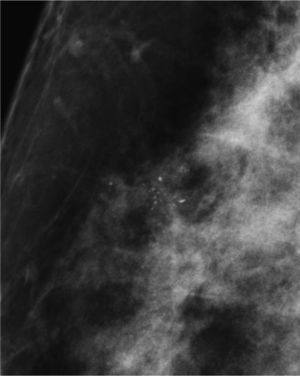 Microcalcificaciones indeterminadas agrupadas. Biopsia con aguja gruesa: columnar alteration with prominent apical scouts and secretions (CAAPS).