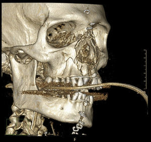 Reconstrucción tridimensional de TAC facial; se aprecia la línea de fractura mandibular a nivel de la sínfisis, fractura de ambos maxilares superiores y fractura conminuta del tabique nasal óseo y de los huesos propios nasales.