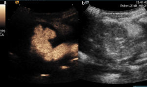 A)Imagen específica de armónicos con contraste de un riñón con un RVU gradoiii-iv. B)Ecografía fundamental o en modoB de un riñón con un RVU gradoiii-iv.