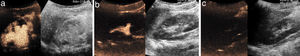 A)Imagen dual ecográfica modo contraste y fundamental de un riñón con un RVU gradoiv-v. B)Imagen dual ecográfica modo contraste y fundamental de un riñón con un RVU gradoii. C)Imagen dual ecográfica modo contraste y fundamental de un riñón sin observarse RVU.