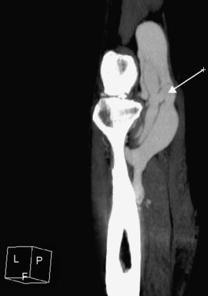 Sección sagital oblicua de tomografía computarizada de miembros inferiores con contraste yodado en fase arterial de región poplítea en la que se observa fístula arteriovenosa poplítea.