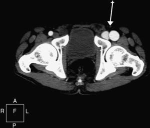 Sección axial de tomografía computarizada de miembros inferiores con contraste yodado en fase arterial de región iliofemoral en la que se observa repleción precoz del sistema venoso dependiente de la extremidad inferior izquierda por la presencia de una FAV a nivel distal.