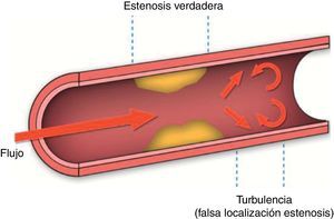 Artefacto de sobrestimación de la estenosis real causado por flujo turbulento.