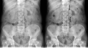 Radiografía simple abdominal en decúbito supino. A la izquierda, radiografía original; a la derecha, detalles: restos fecales (*), punto de transición (flechas) y gas distal (A).