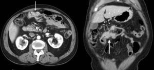 TC multidetector en el plano axial (izquierda) y coronal (derecha). Engrosamiento mural estenosante del colon transverso sugestivo de neoplasia (flechas).