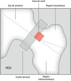 El triángulo o área de Ward (en rojo) presenta una concentración mínima de trabéculas óseas.