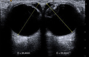 Medidas normales de ambos globos oculares, desde la córnea hasta la retina.