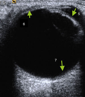 5-Cámara anterior. 6-Esclera, coroides y retina (indistinguible). 7-Pared posterior.
