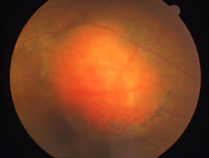 Fotografía a color de fondo de ojo izquierdo. Se evidencia masa subretiniana color naranja, ovoide, con pigmento en sus bordes y desprendimiento seroso retiniano.
