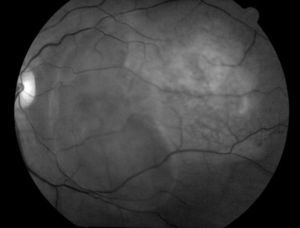 Fotografía de fondo de ojo con filtro verde. Destaca el área de desprendimiento seroso que involucra región macular. Se observa también la tumoración coroidea delimitada con vasos retinianos pasando por encima de la lesión.