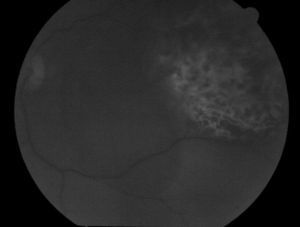 Fase coroidea de la fluorangiografía, que muestra una hiperfluorescencia temprana y llenado de vasos tumorales.