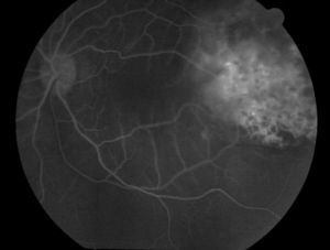 Fase arteriovenosa de la fluorangiografía. Se destaca una mayor hiperfluorescencia en el borde nasal de la lesión tumoral simultáneamente con los vasos retinianos normales.