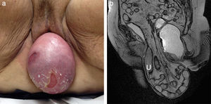Prolapso vaginal y uterino de gran magnitud en mujer de 84 años de edad (a). En un plano sagital FIESTA obtenido en reposo (b) es visible el contenido de la bolsa protuberante: grasa peritoneal (peritoneocele), asas intestinales (enterocele) y el útero prolapsado (U).