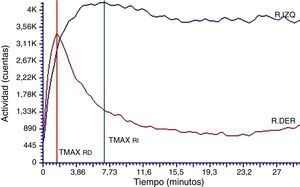 Curva renográfica basal con patrón de eliminación alterado para el riñón izquierdo. La curva renográfica muestra el TMAX conservado para el RD. La curva renográfica del RI es compatible con un patrón de eliminación obstructivo, mostrando retraso al valor pico de la curva (TMAX alargado) y sostenimiento de la etapa de eliminación (T50%Mx >30).